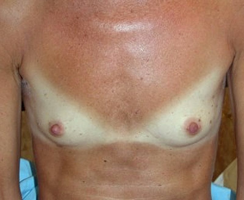 Breast Augmentation Before & After