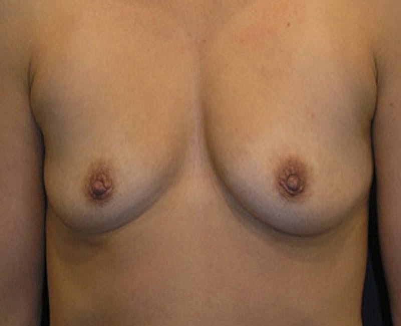 Breast Augmentation Before & After