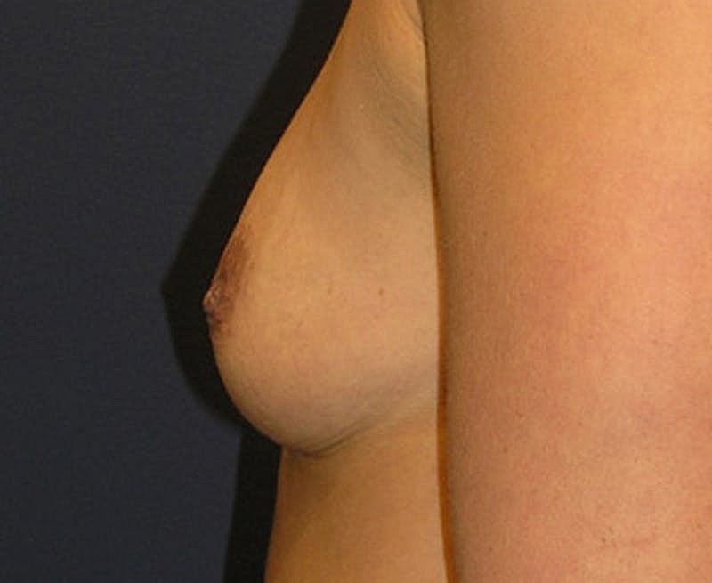 Breast Augmentation Before & After