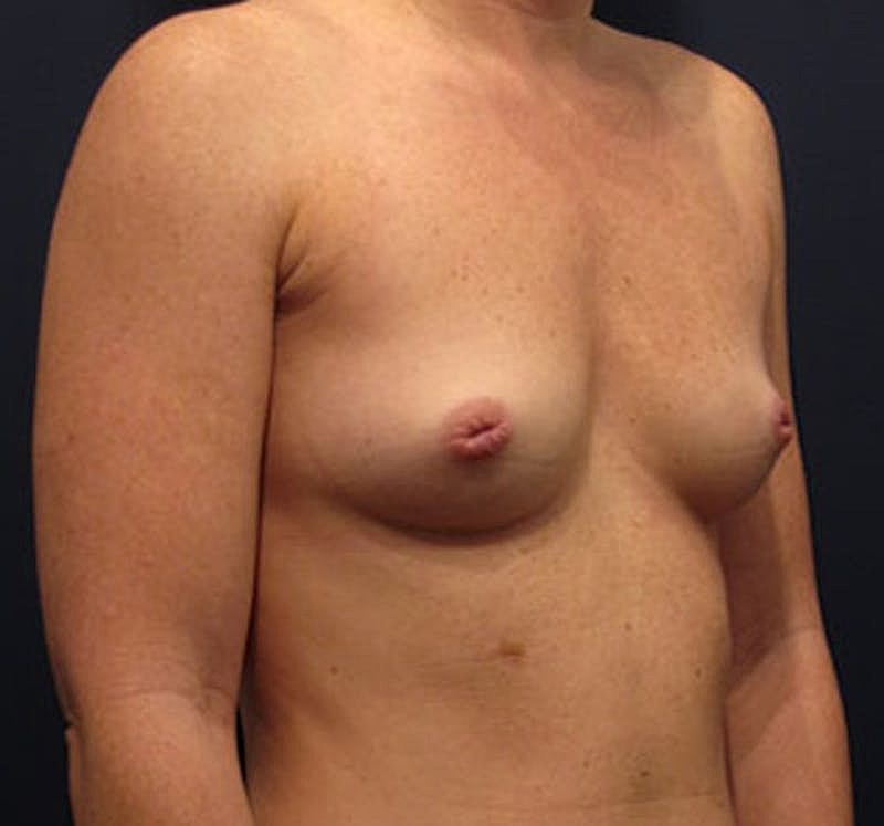 Breast Augmentation Before & After