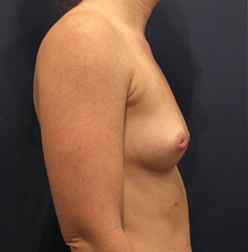 Breast Augmentation Before & After