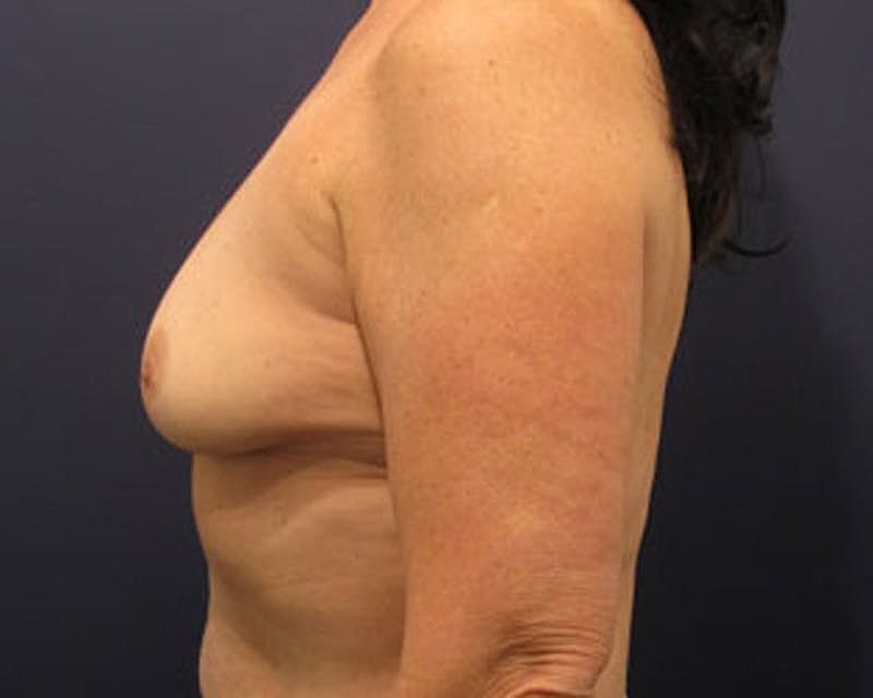 Breast Augmentation Before & After