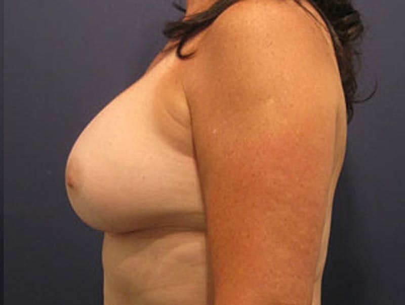 Breast Augmentation Before & After