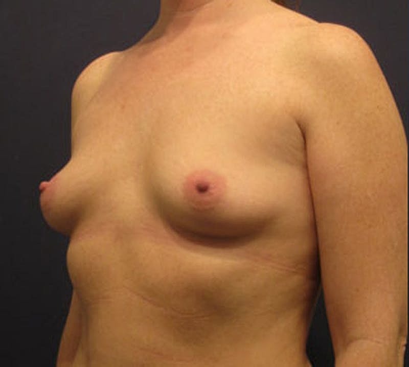 Breast Augmentation Before & After