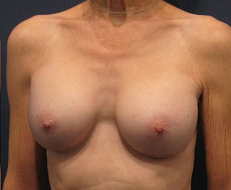 Breast Augmentation Before & After