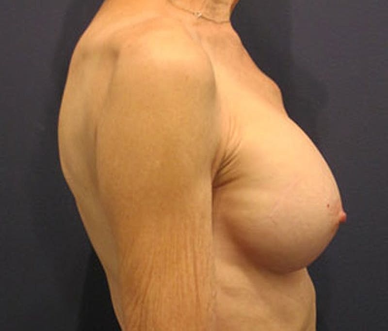 Breast Augmentation Before & After