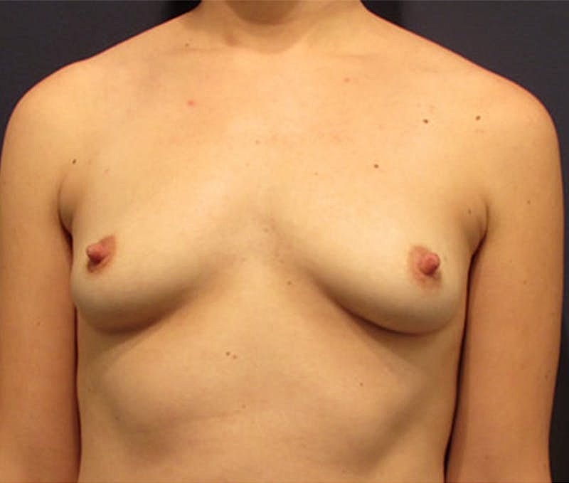 Breast Augmentation Before & After