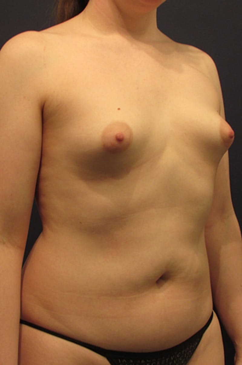 Breast Augmentation Before & After