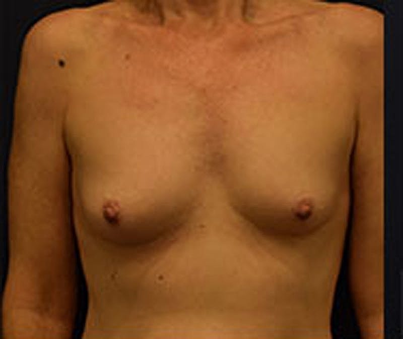 Breast Augmentation Before & After