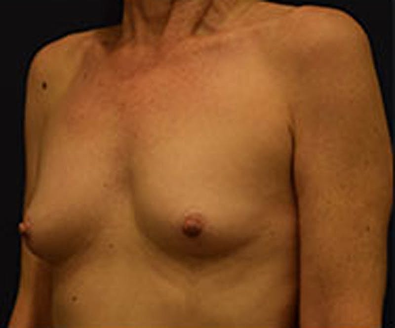 Breast Augmentation Before & After