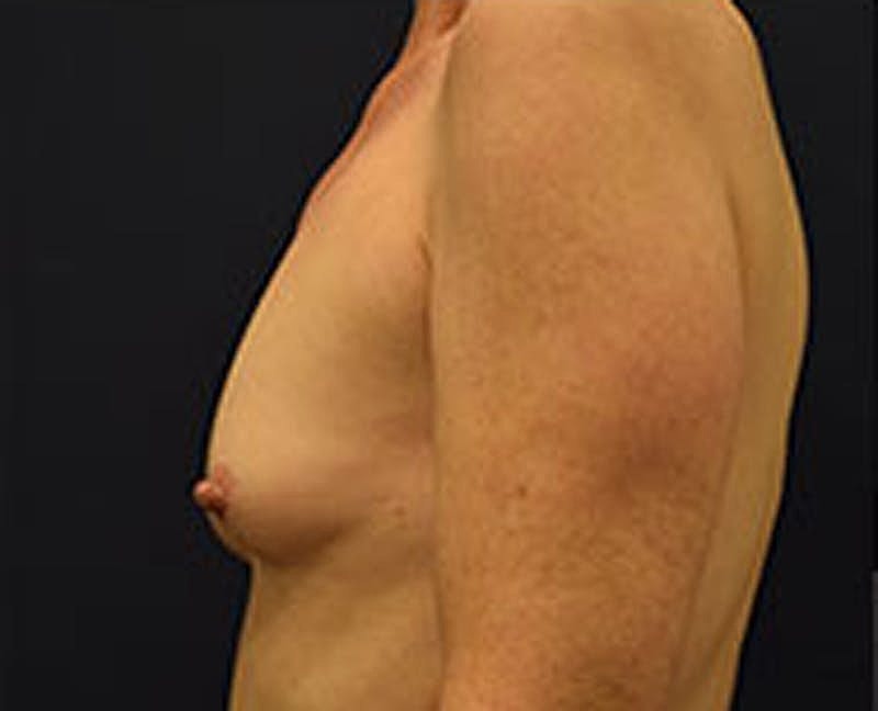 Breast Augmentation Before & After