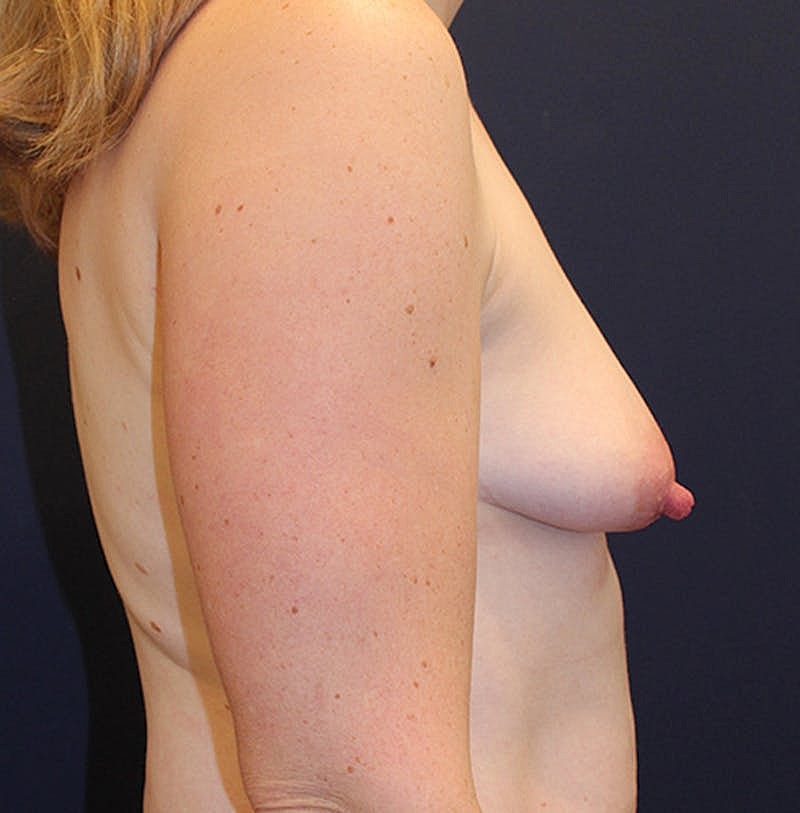 Breast Augmentation Before & After