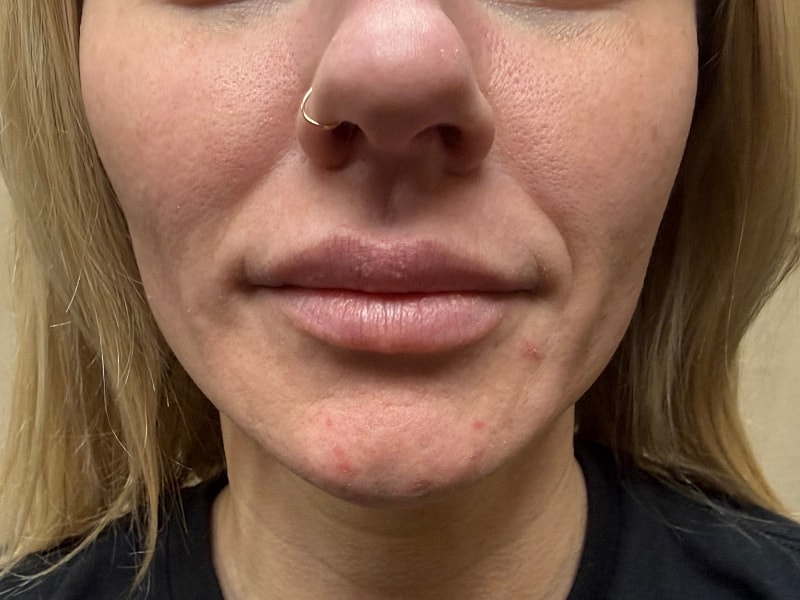 Fillers Gallery Before & After