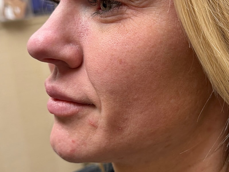 Fillers Gallery Before & After