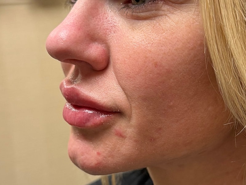 Fillers Gallery Before & After