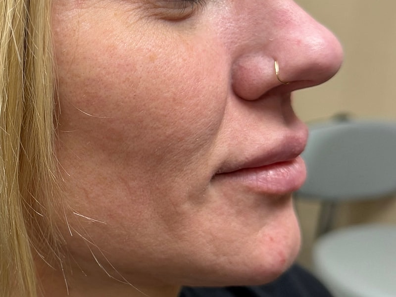 Fillers Gallery Before & After