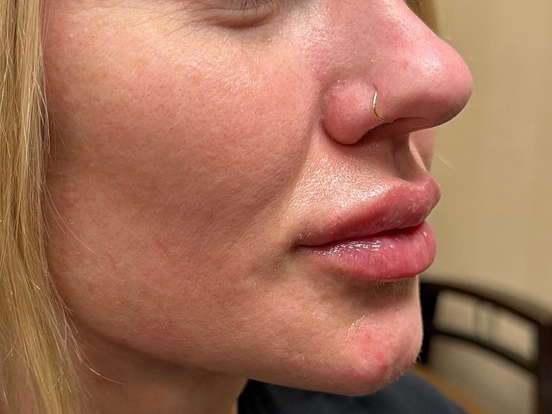 Fillers Gallery Before & After