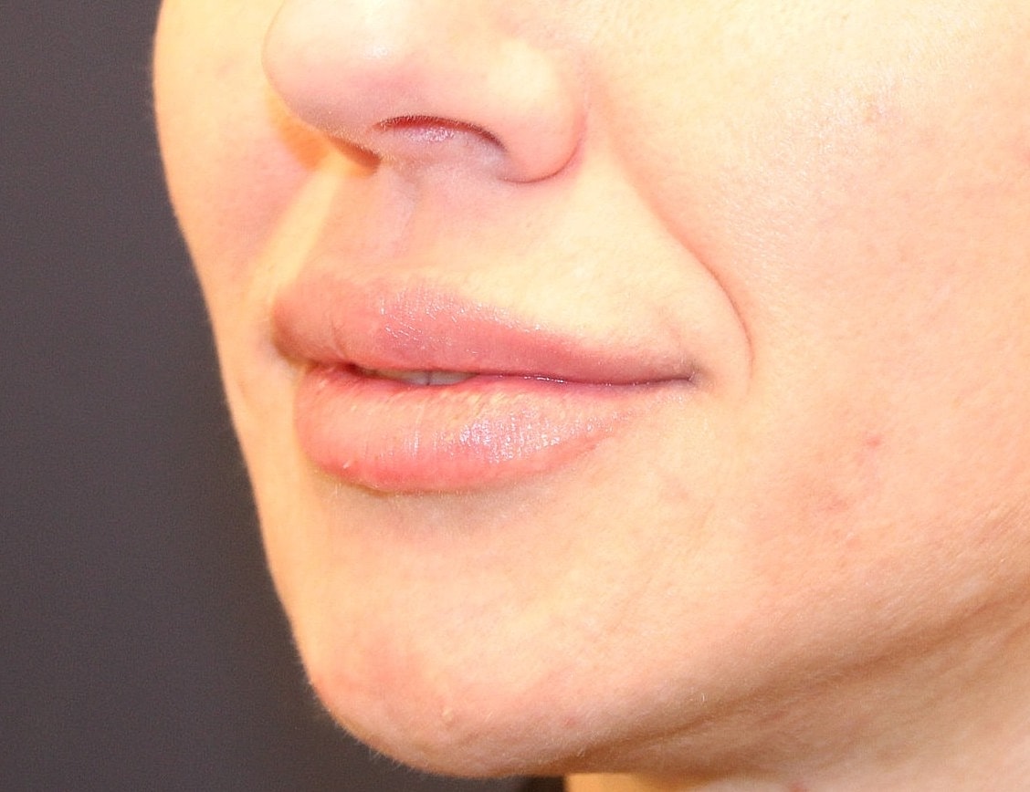 Fillers Gallery Before & After