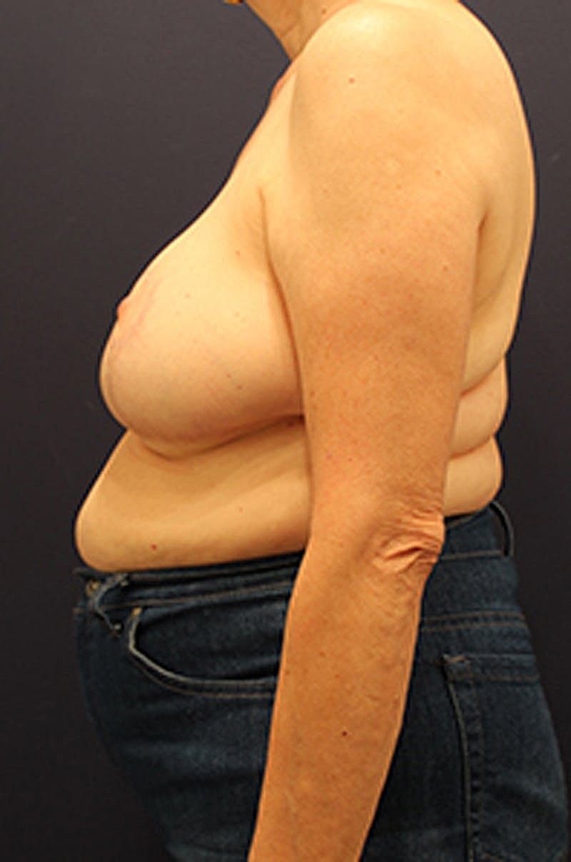 Breast Reduction Before & After
