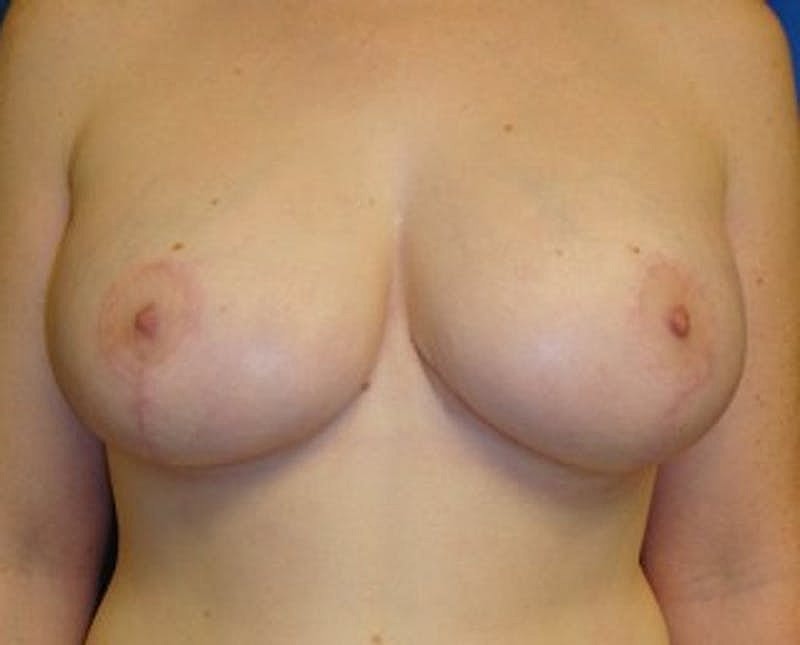 Breast Reduction Before & After