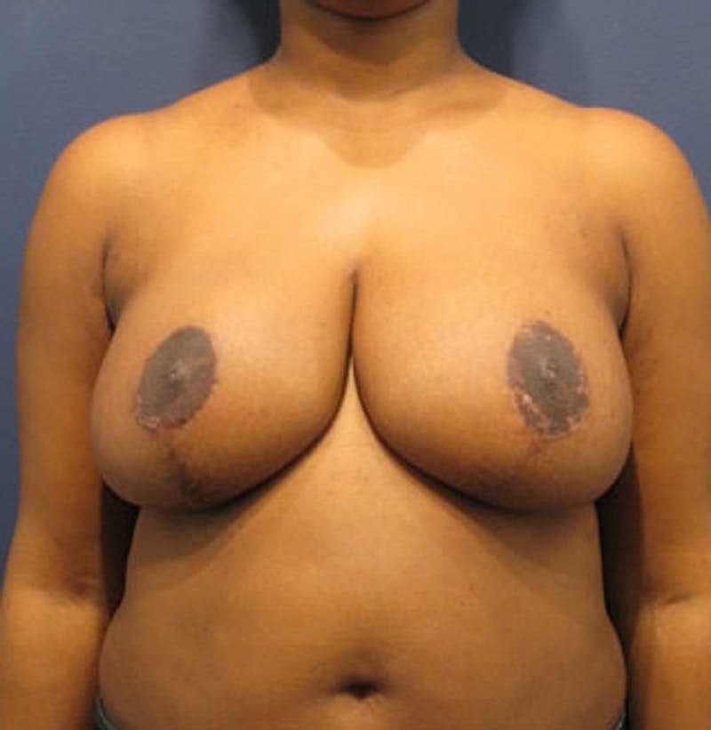 Breast Reduction Before & After