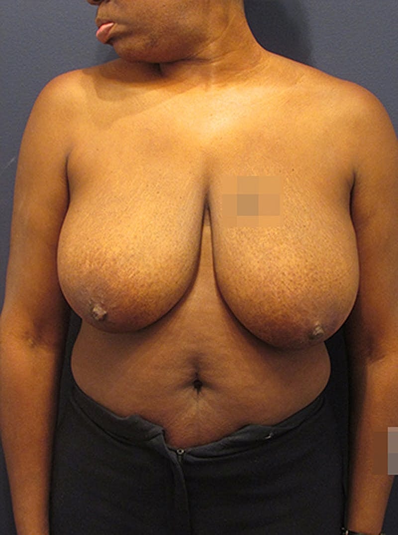 Breast Reduction Before & After