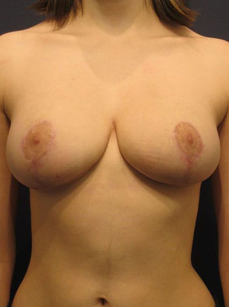 Breast Reduction Before & After