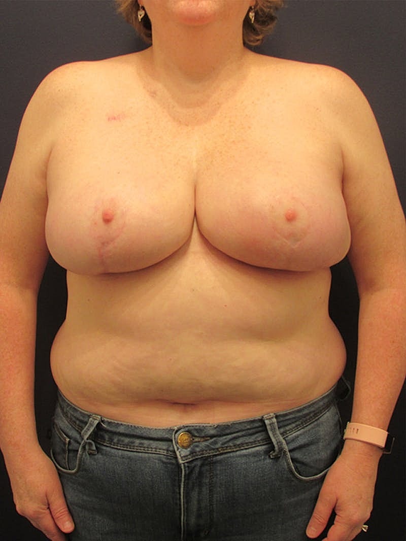 Breast Reduction Before & After