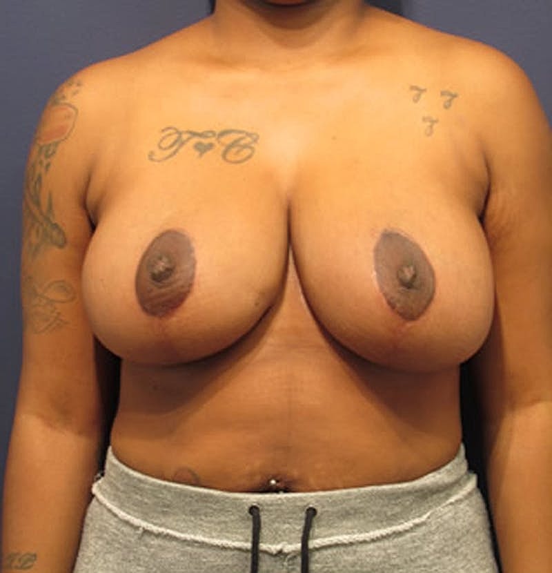 Breast Reduction Before & After