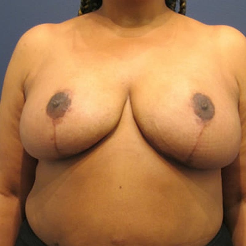 Breast Reduction Before & After