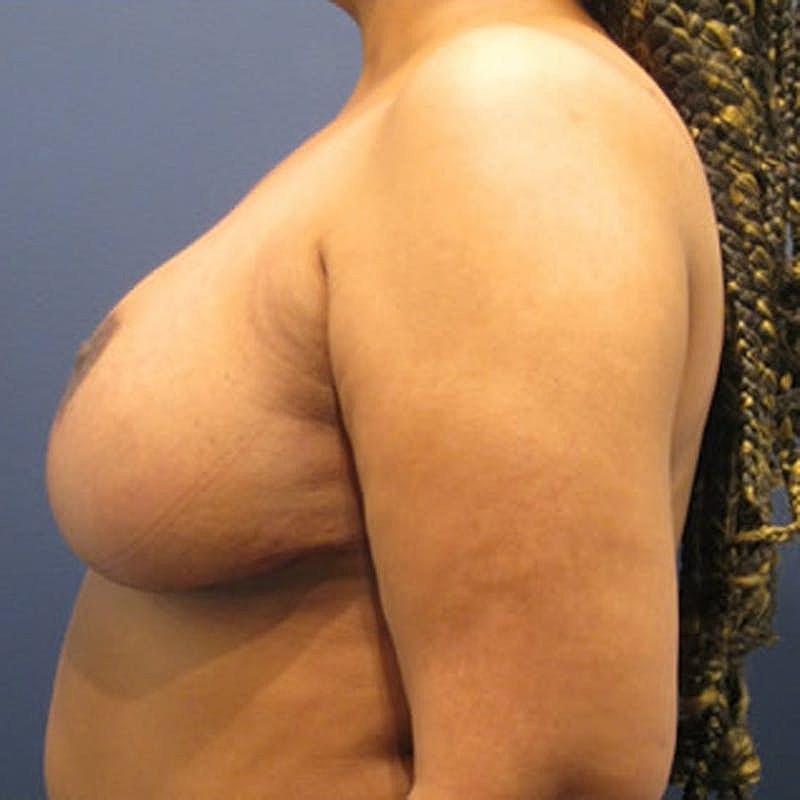 Breast Reduction Before & After