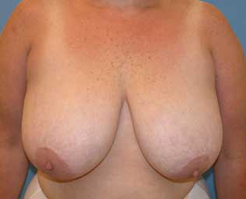 Breast Reduction Before & After