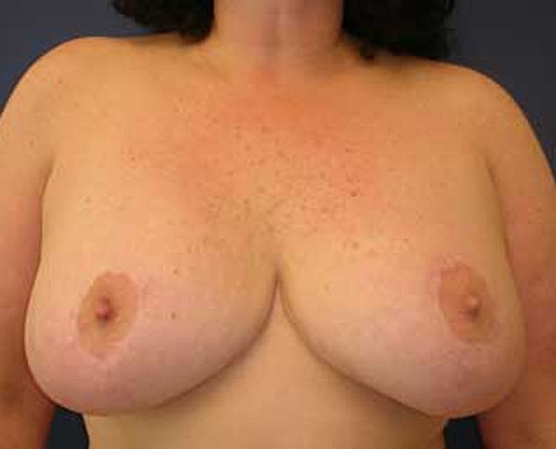 Breast Reduction Before & After