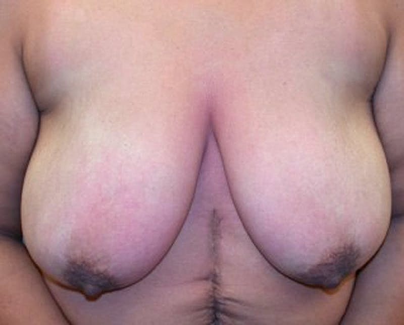 Breast Reduction Before & After