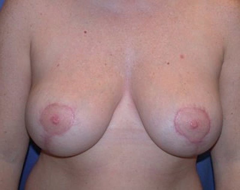 Breast Reduction Before & After