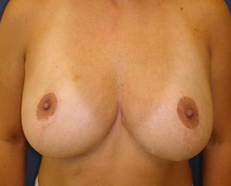 Breast Reduction Before & After