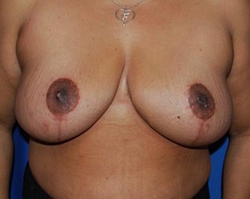 Breast Reduction Before & After