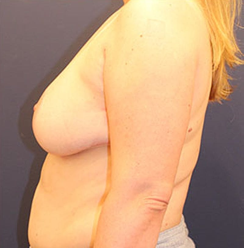 Breast Reduction Before & After