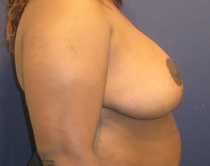 Breast Reduction Before & After