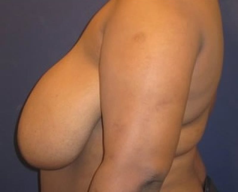 Breast Reduction Before & After