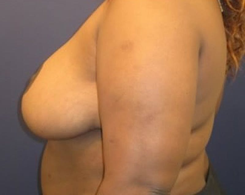Breast Reduction Before & After