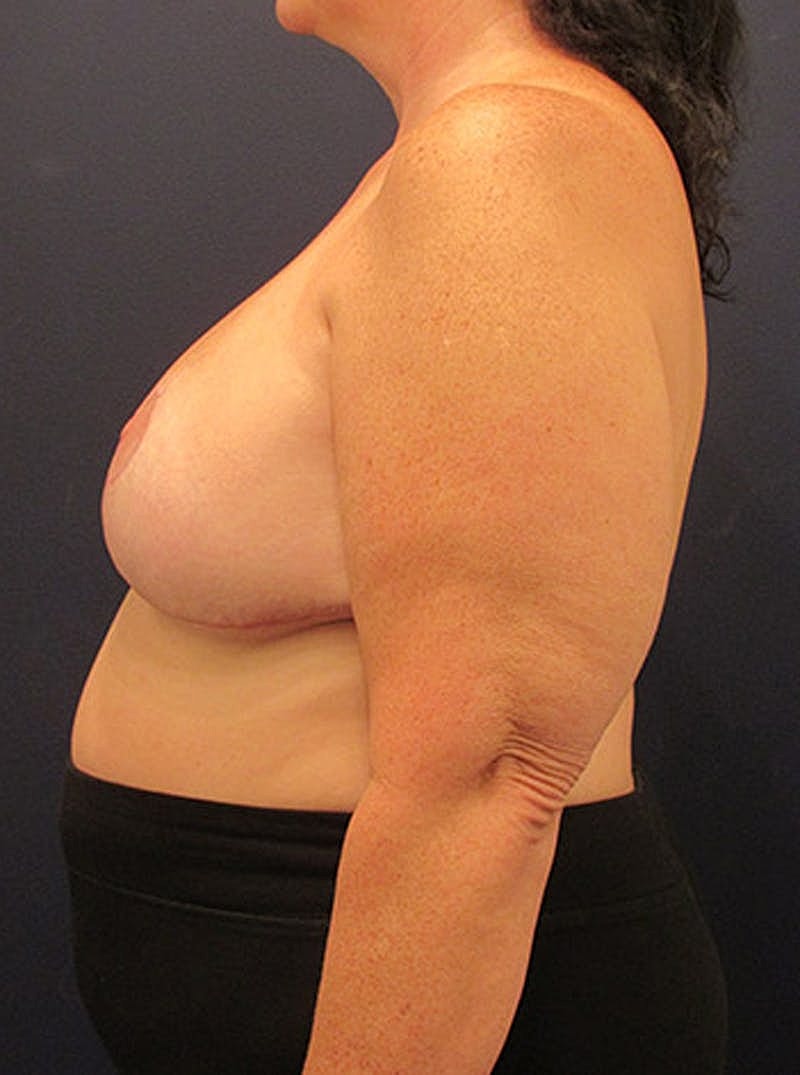 Breast Reduction Before & After
