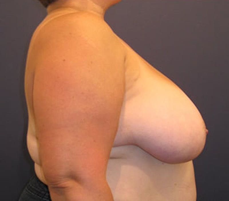 Breast Reduction Before & After