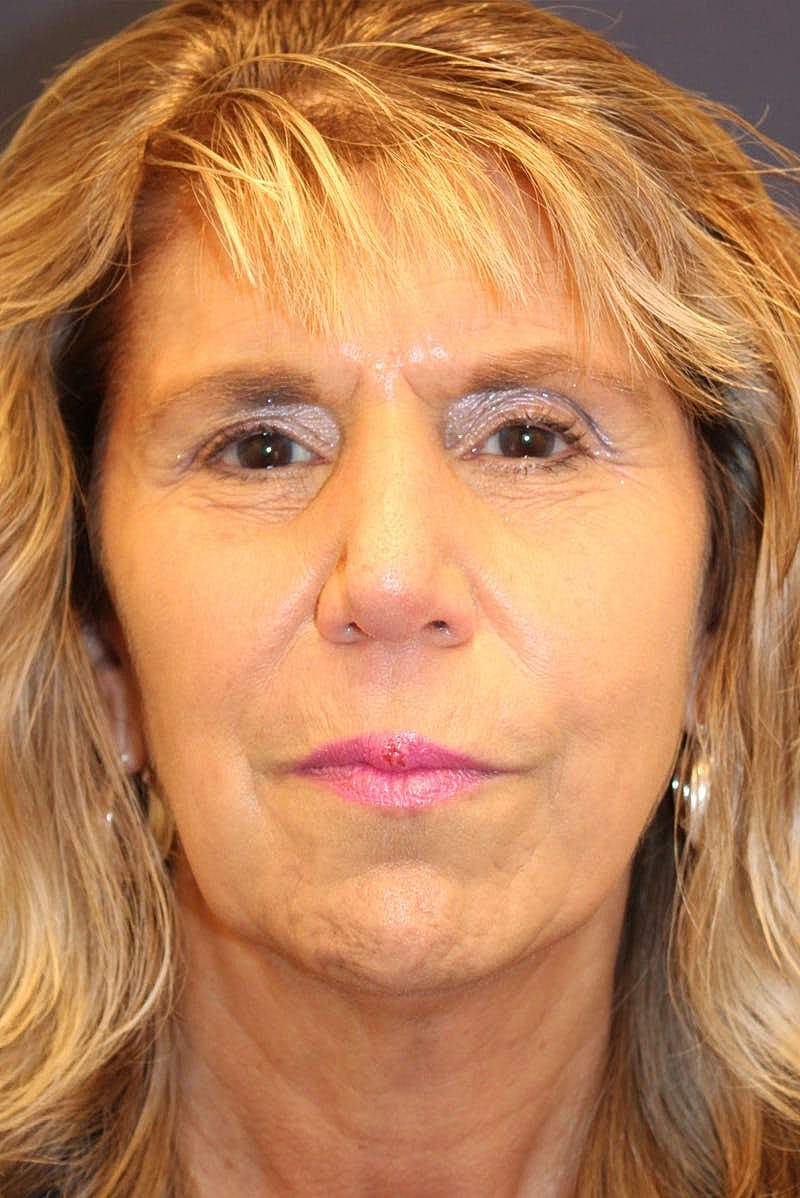 Sofwave Before & After