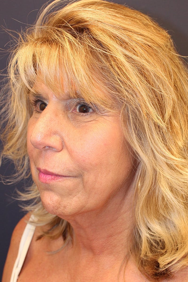 Sofwave Before & After