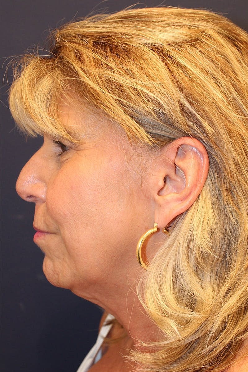 Sofwave Before & After