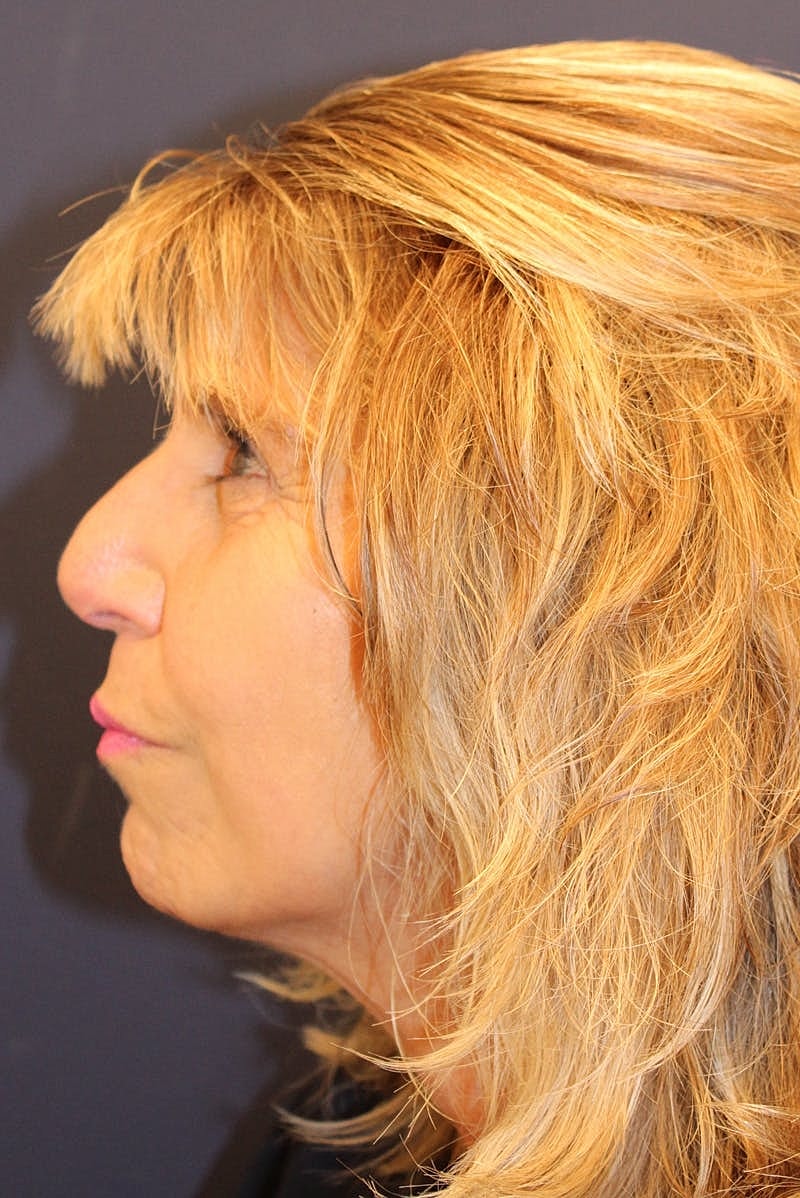 Sofwave Before & After