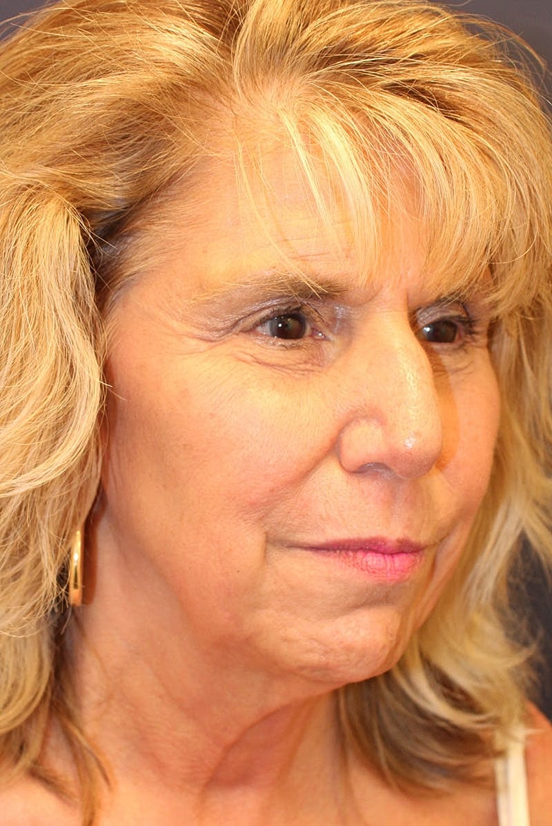 Sofwave Before & After