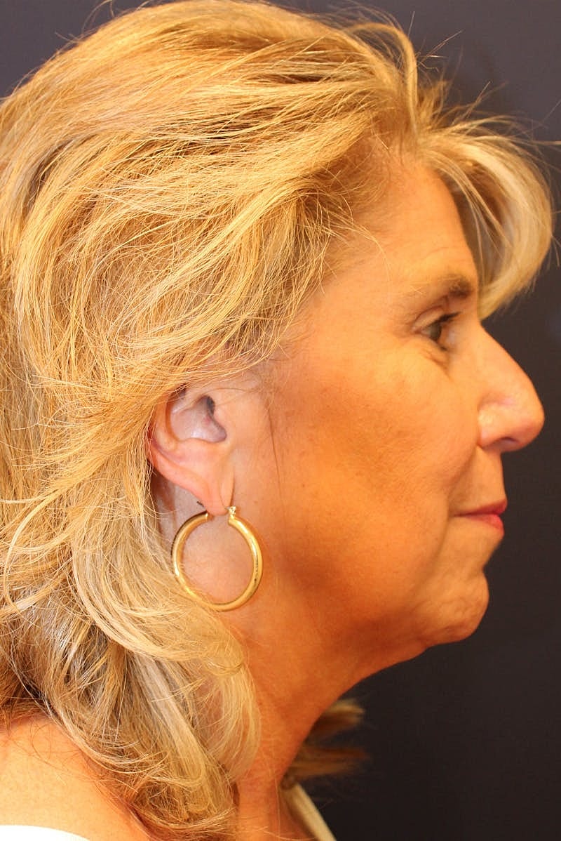 Sofwave Before & After