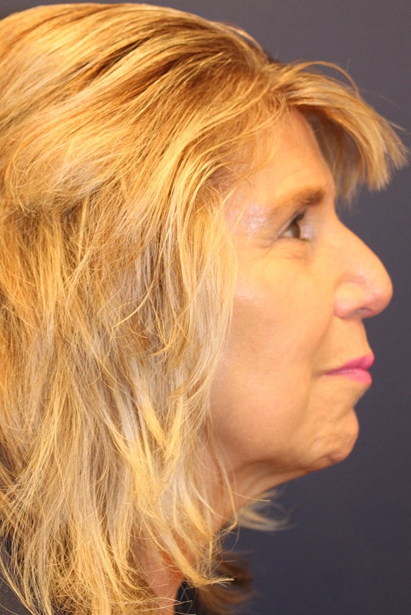 Sofwave Before & After